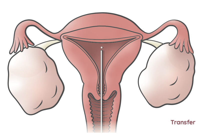 Grafische Darstellung eines Embryotransfers.