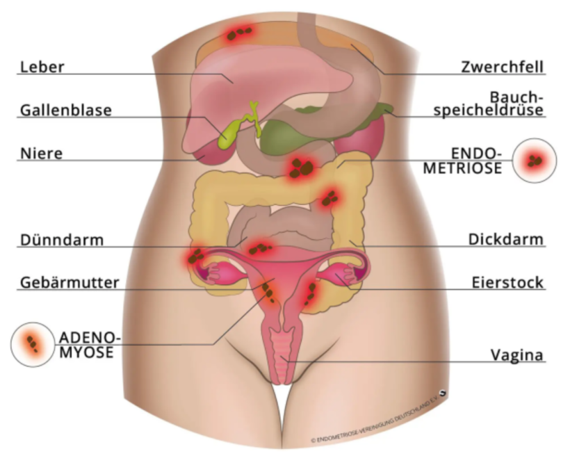 Endometrioseherde