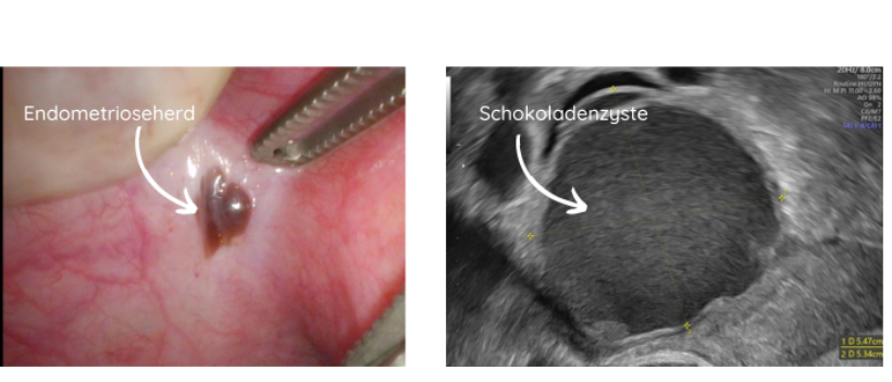 Bild links zeigt eine laparoskopische Aufnahme eines Endmetrioseherdes und rechts zeigt ein Ultraschallbild einer Schokoladenzyste.